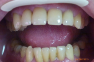 Лечение зубов в центре красоты и здоровья "Аполония" - 